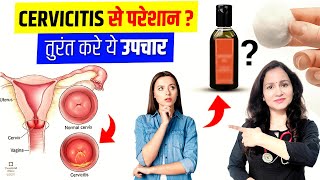 Ayurvedic Treatment For Cervicitis  CERVICITIS TREATMENT  बच्चेदानी के मुख की सूजन  कारण और इलाज [upl. by Zere]