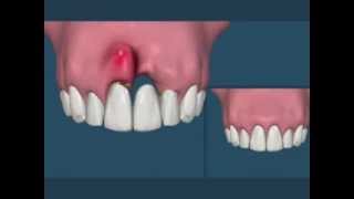 Compare Ponte Fixa ou Implante [upl. by Malcah]