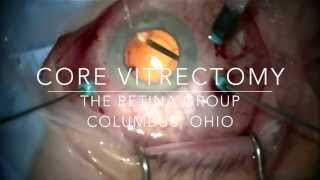 Core Vitrectomy During 25 gauge Vitrectomy Surgery [upl. by Ennalorac]