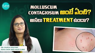 Molluscum Contagiosum Treatment in telugu  Molluscum Contagiosum Cream Virus and Symptoms Keha [upl. by Raknahs6]