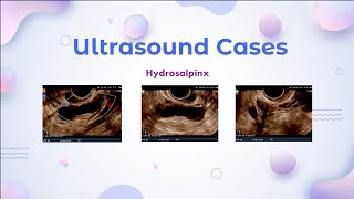 Hydrosalpinx  Ultrasound Cases [upl. by Dorsey]