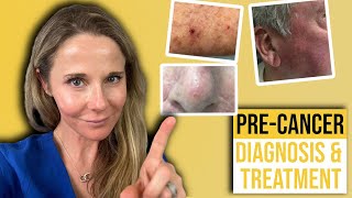 Actinic keratosis treatment guide from a Dermatologist [upl. by Yenduhc548]