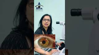 Laser for Glaucoma YAG Iridotomy [upl. by Kazimir]