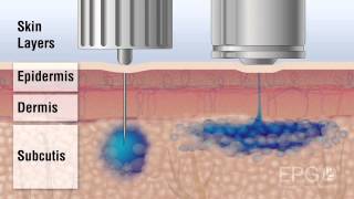 Needle vs InsuJet™ Nozzle injection [upl. by Laforge]