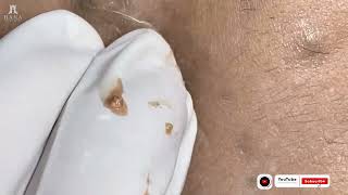 Big Cystic Acne Blackheads Extraction Blackheads amp Milia Whiteheads Removal Pimple Popping shorts [upl. by Esther]