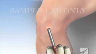 Knee Arthroscopy [upl. by Ameg]