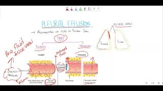 Pleural effusionTransudate vs exudate Light criteria [upl. by Nylessoj]