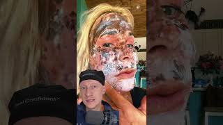 SHOCKING CO2 Laser Recovery Is Normal  Plastic Surgeon Reacts [upl. by Amalbena]