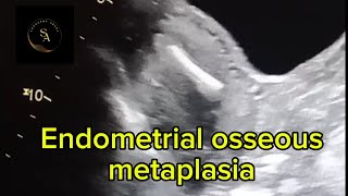 Endometrial osseous metaplasia [upl. by Hyps]