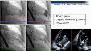 Pseudoaneurysm Therapy  Jacqueline Saw MD [upl. by Idonna]