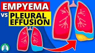 Empyema vs Pleural Effusion EXPLAINED [upl. by Dinsmore]