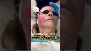 Phoenix CO2 laserco2 laser rejuvenecimientofacial [upl. by Averell]