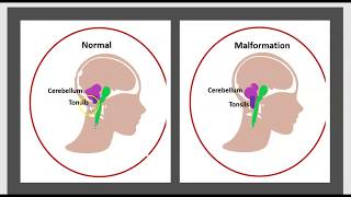 La Syringomyélie Malformation dArdnold Chiari LHydrocéphalie Maladie du Filum Syrinx Traitement 3m [upl. by Johst463]