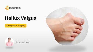 Hallux Valgus  Orthopedic Surgery Video Lectures  Medical Education  VLearning™ [upl. by Levan747]