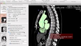 Generating 3D models using Osirix [upl. by Kedezihclem]