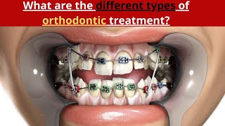 What are the different types of orthodontic treatment [upl. by Appleby]