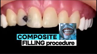 Tooth filling procedure  tooth filling cavity  dental filling procedure dentist ndc [upl. by Grimbald]