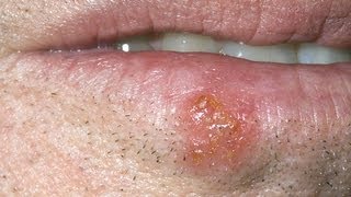 DermTV  How Long Are Cold Sores Contagious DermTVcom Epi 397 [upl. by Rubia]