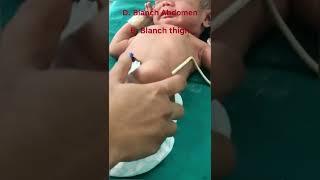 How to check for jaundiceicterus in a newborn [upl. by Ahsercul]