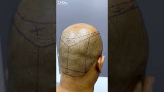 Cara Clinics REAL Hair Transplant Results That Will SHOCK You [upl. by Yaj]