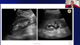 Hydronephrosis vs Normal Kidney [upl. by Annawek]