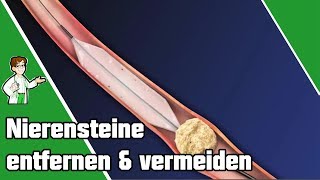 Nierensteine entfernen und vermeiden  SO geht es 👨‍⚕️ [upl. by Teplica]