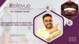 FACETTES DENTAIRES  PRIX EN TURQUIE  BON PLAN OU ARNAQUE  TOUT LES SECRETS EN DÉTAILS [upl. by Llimaj451]