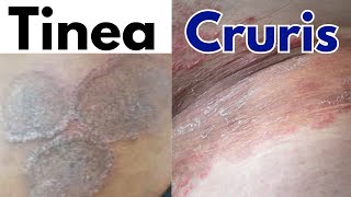 Tinea Cruris jock itch  Tinea cruris symptoms treatment  Jock itch fungal infection [upl. by Haley]