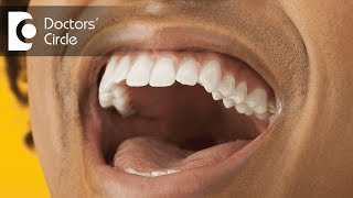 Causes and management for severe dry mouth  Dr Jayaprakash Ittigi [upl. by Ueihtam829]