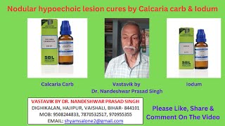 Nodular hypoechoic lesion cures by Calcaria carb amp Iodum [upl. by Jar429]