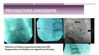 Nukleoplastie  Discus  Dekompression durch intradiskale Coblation lumbal und zervikal [upl. by Segalman]