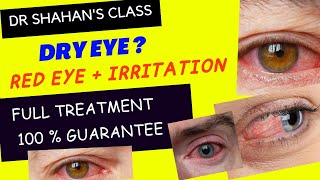 Dry eye treatment  Dr Shahans Class  100  guarantee dryeyetreatment [upl. by Yecniuq]