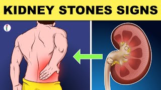 Kidney Stones Symptoms  All You Need to Know [upl. by Aynekal107]