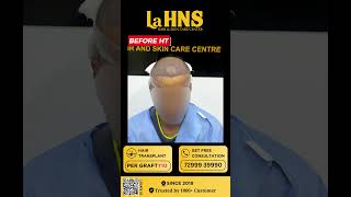 quotRegain Your Confidence Regrow Your Hairquot  Lahns  Hair transplant  Coimbatore [upl. by Assener745]