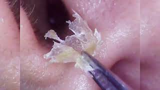 Ultimate Ear Wax Removal  Satisfying Ear Cleaning for Clear 4 [upl. by Ahsiyn]