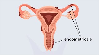 What is endometriosis  Animation  Minute to Understanding [upl. by Tuhn]