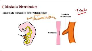 USMLE ACE Video 157 Common Gastrointestinal Disorders [upl. by Atima]