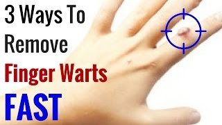 How to Get Rid of Warts on Fingers Fast  3 Natural Wart Remedies [upl. by Penney171]