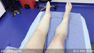 Lipedema Solution  Leg Liposuction Surgery Results  Lipo 360°  Expert Dr Thomas Su [upl. by Jessalyn]