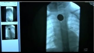 Toddler Swallows a Coin Part 2  Bizarre ER [upl. by Chaddie267]