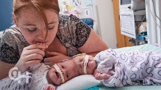 Conjoined Twins Abby and Erin Delaney A Year in the Life [upl. by Naitsabas]