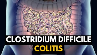 CLOSTRIDIUM DIFFICILE COLITIS Causes Signs and Symptoms Diagnosis and Treatment [upl. by Felecia801]