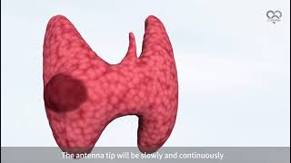 Thyroid ablation Canyon MWA [upl. by Nekcerb]