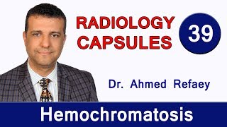 Capsule 39  Hemochromatosis [upl. by Urbas]