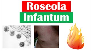 Roseola Infantum Sixth Disease  Symptoms Fever amp Rash in Infants Diagnosis Treatment [upl. by Chapell648]