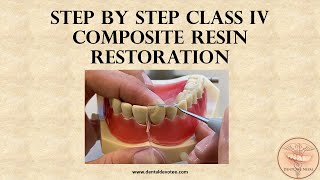 STEP BY STEP  Class IV dental restoration with composite [upl. by Nudd684]