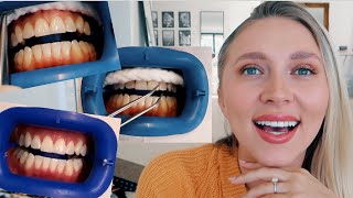 IS IT WORTH IT Professional teeth whitening BEFORE amp AFTER [upl. by Ahsenrac]