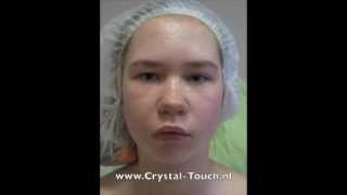 Congenital Facial Paralysis Nadja 14 after 2 Crystal Touch treatments Moscow [upl. by Idnis691]