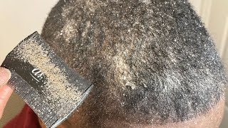 Close up Scalp Cleanse ASMR We Scratch You Relax [upl. by Modnarb142]