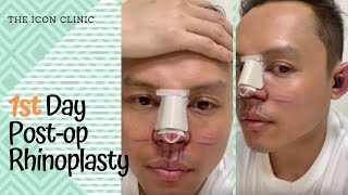 Rhinoplasty In the Philippines 1st Day Post Opp [upl. by Kissiah]